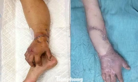 Tin mới nhất về kỳ tích ca phẫu thuật giúp thai phụ có tay để đón song sinh 