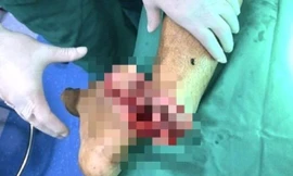Bị chém gần đứt lìa chân khi mang hung khí đi tìm đối thủ
