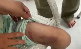 Bé gái 9 tuổi bị mẹ ruột cùng người tình đánh dã man trong phòng trọ ở TPHCM