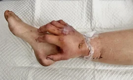 Ca phẫu thuật hy hữu: Nuôi sống bàn tay trên chân bệnh nhân, chờ ngày ghép lại tay 