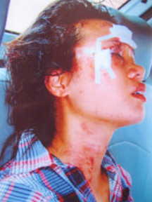 Oanh trong một lần bị Huy hành hung vào tháng 8-2010