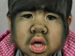 Jing Jing mắc hội chứng Hypertrichosic Universalis khiến mặt và toàn thân mọc đầy lông, tóc. . Jing Jing mắc hội chứng Hypertrichosic Universalis khiến mặt và toàn thân mọc đầy lông, tóc.