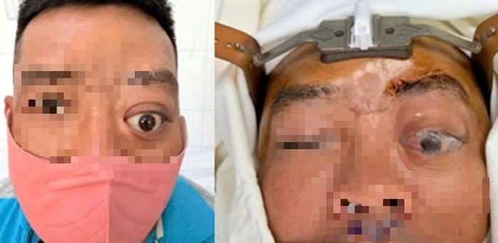 Người đàn ông có một mắt bị lồi