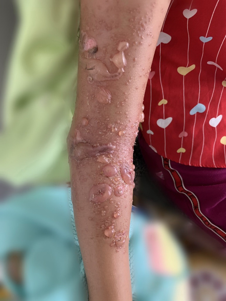 Cánh tay bệnh nhi khi bị sứa "cắn" (ảnh: BVCC) Đi tắm biển bị sứa 'cắn' nhập viện ảnh 1