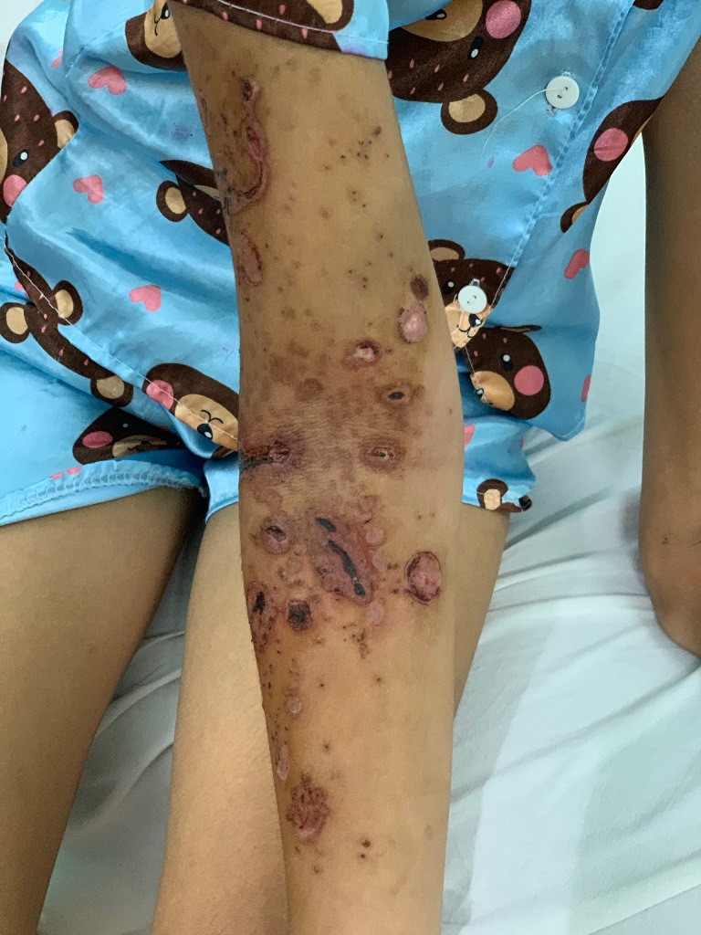 Sau khi được điều trị tại bệnh viện (ảnh: BVCC) Đi tắm biển bị sứa 'cắn' nhập viện ảnh 2