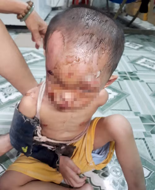 Bé trai bị bỏng nặng vùng mặt. Ảnh người dân cung cấp. Bé trai bị bỏng nặng vùng mặt. Ảnh người dân cung cấp.