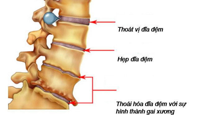 Biểu hiện của bện thoát vị đĩa đệm