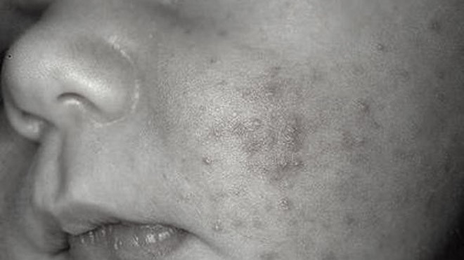 Trẻ em hay bị vẩy phấn trắng ở mặt, nhất là 2 má