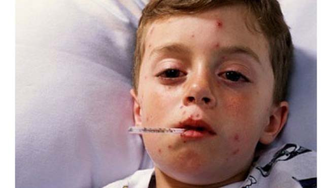 Trẻ mắc bệnh thủy đậu