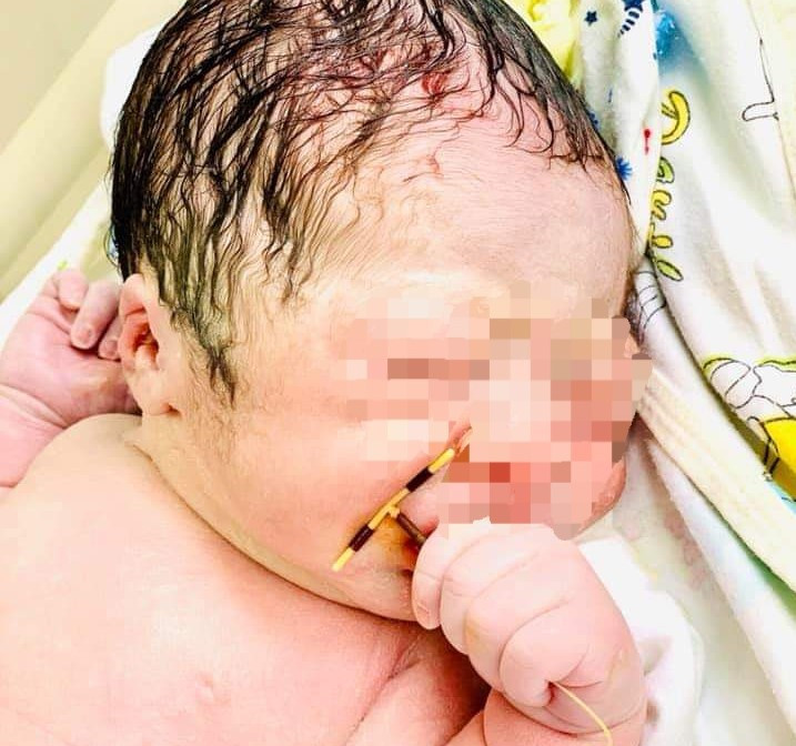 Hy hữu bé trai chào đời cùng vòng tránh thai của mẹ