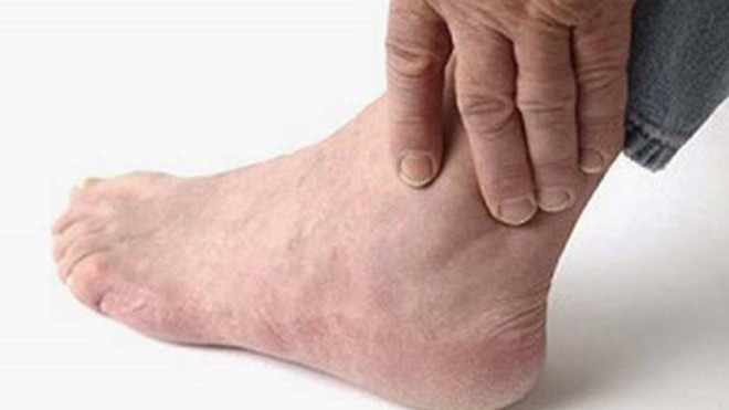 Vẩy nến bàn chân