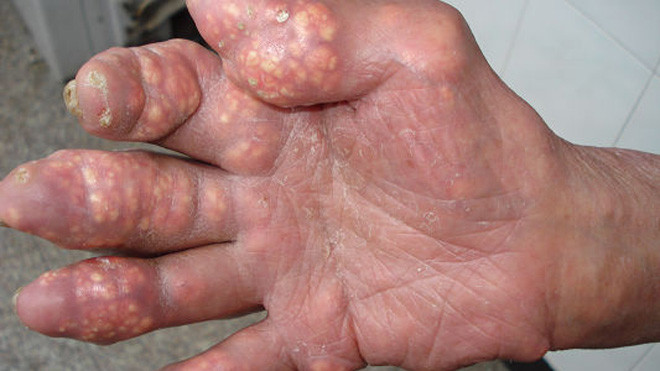 Bệnh nhân bị gút ở khớp ngón tay.