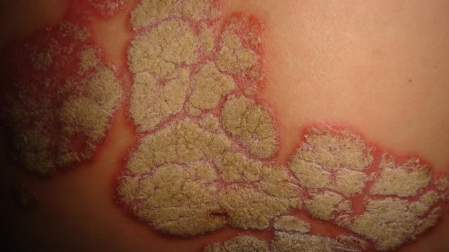 Thương tổn trên da ở bệnh nhân vẩy nến