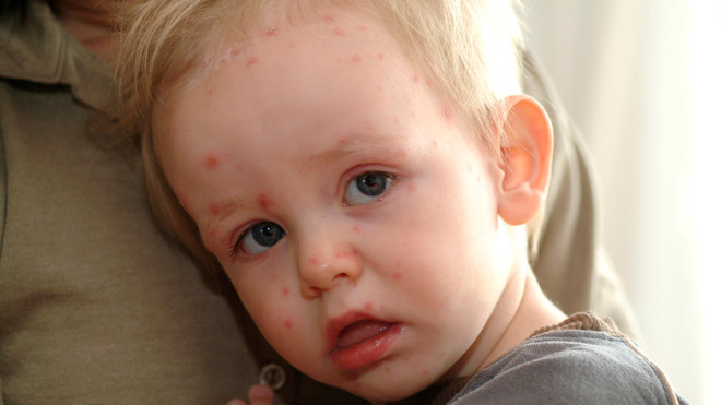 Bệnh tay chân miệng thường tấn công trẻ nhỏ