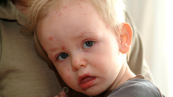 Trẻ dưới 5 tuổi có nguy cơ mắc bệnh tay chân miệng cao