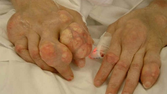 Người bệnh gout sau 5-7 năm nếu không dùng đúng thuốc và có chế độ ăn uống hợp lý sẽ chuyển sang giai đoạn 3 là giai đoạn nặng nhất, nổi hạt tophi, co rút chân tay, đau đớn và đi lại khó khăn