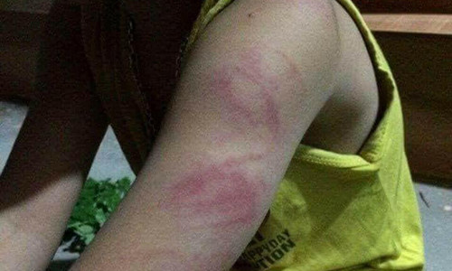 Học sinh lớp 1 bị đánh tím tay vì đọc viết chưa thông thạo