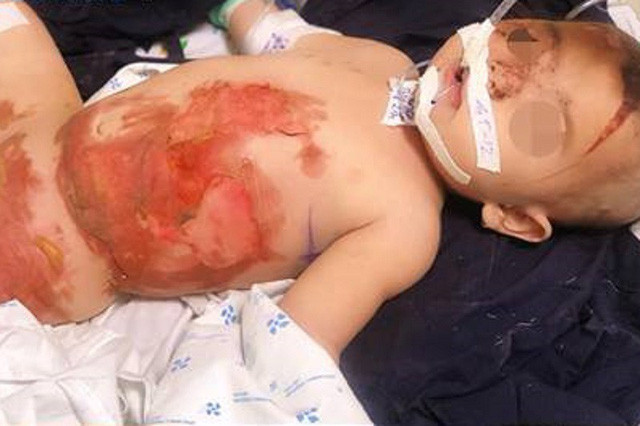 Bệnh nhi bỏng nặng sau khi bị bình nước sôi đổ lên người