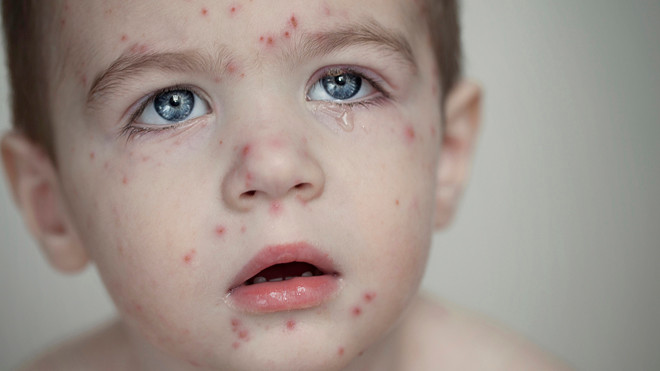 Thủy đậu thường “tấn công” trẻ nhỏ