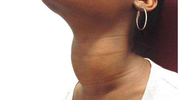 Một trường hợp bướu cổ