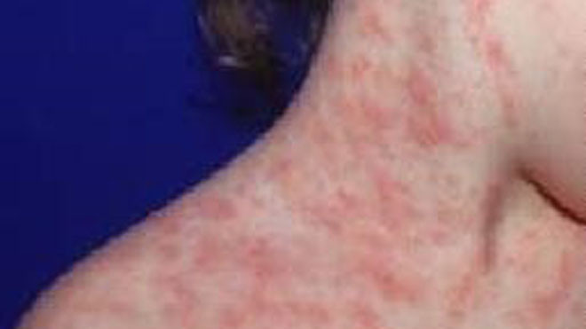 Bệnh nhân vẩy phấn hồng