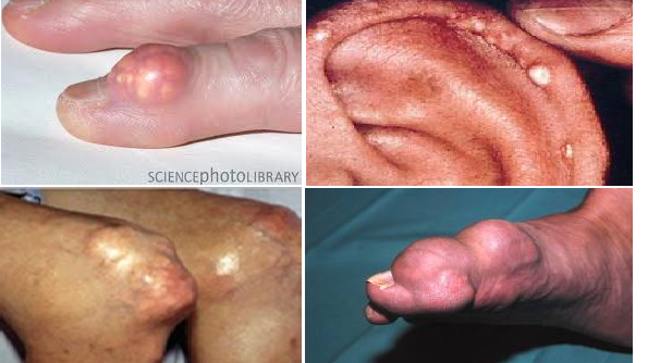 Hạt tophi xuất hiện ở nhiều vị trí trên cơ thể bệnh nhân gút