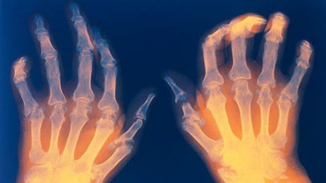 Bàn tay biến dạng do viêm khớp dạng thấp