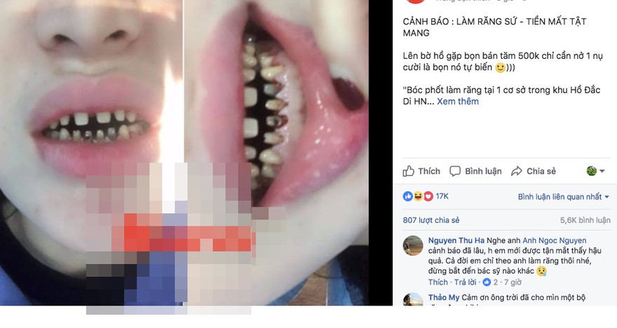  Chị T.N chia sẻ về tình trạng răng sau 2 năm bọc răng sứ.