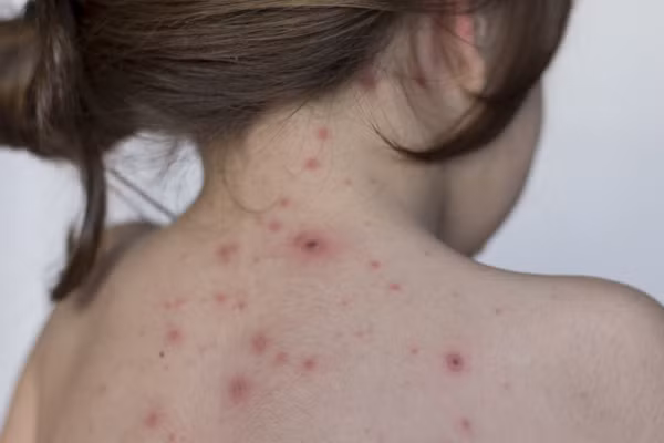 Thủy đậu vốn lành tình nhưng nếu không phát hiện kịp thời và điều trị đúng cách có thể gây ra nhiều biến chứng nguy hiểm khó lường