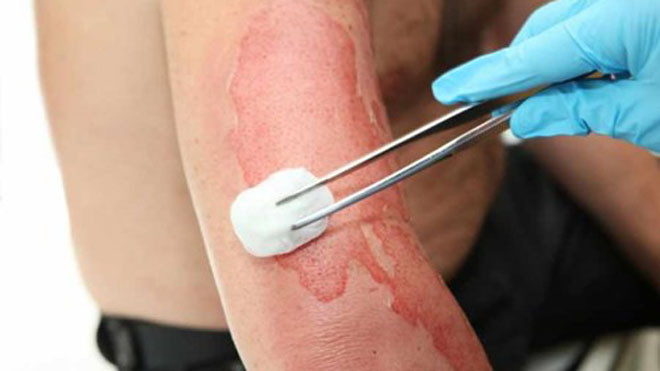  Nếu nạn nhân đang thở, hãy che phủ vùng bị bỏng bằng băng gạc vô trùng, hoặc bằng vải sạch. Ảnh: khoahoc.tv