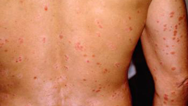 Vẩy nến trên lưng và tay