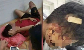 Mâu thuẫn cá nhân, học sinh lớp 8 bị bạn dùng gậy đánh nhập viện