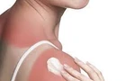 Nắng nóng cực điểm: Cảnh báo bỏng nắng và bệnh da tăng cao