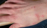 Cảnh báo bệnh hiếm dễ bị bỏ sót từ những tổn thương da kéo dài