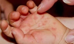 Nhiều ca bệnh tay chân miệng tăng nặng: Bộ Y tế chỉ đạo khẩn