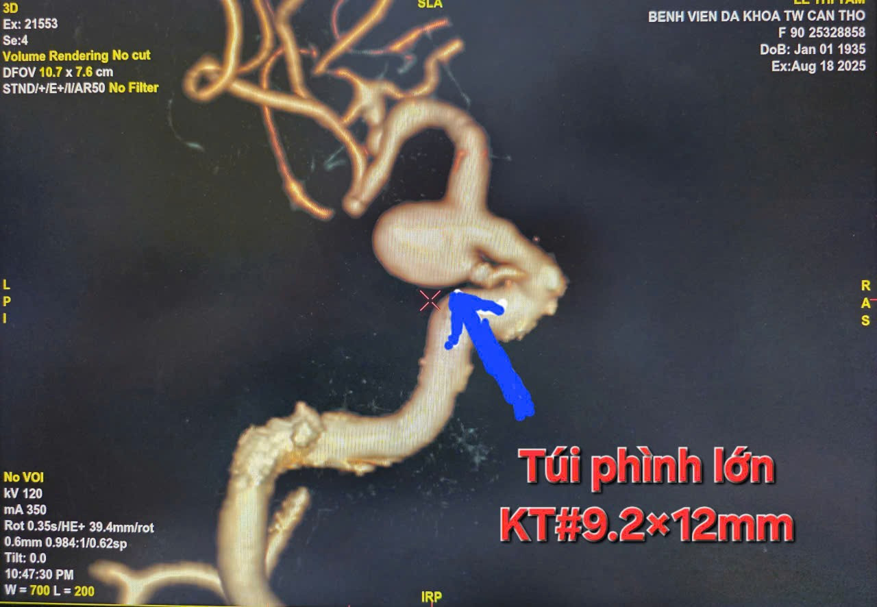 Hình ảnh túi phình kích thước lớn trong đầu cụ bà 90 tuổi.