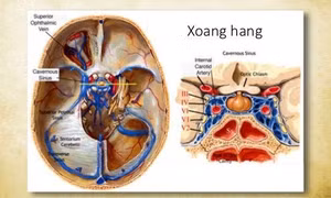 Đau đầu, sổ mũi tưởng nhẹ, nhưng có thể là một căn bệnh cực kỳ tàn khốc