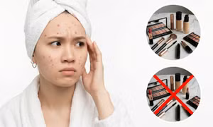 Trang điểm khi trị mụn: Nên hay không? Lời khuyên từ chuyên gia