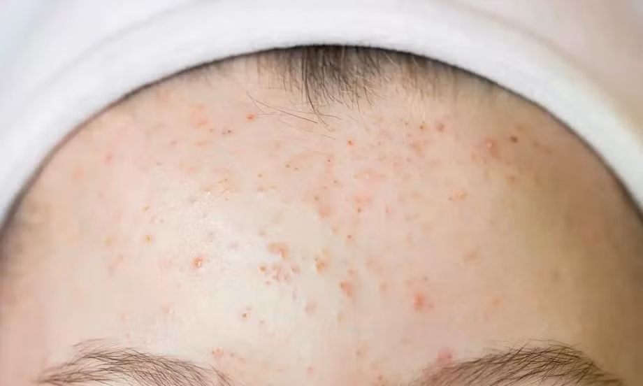 Thủ phạm gây ra mụn trên trán và cách ngăn chặn chúng hiệu quả