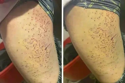 Nguyên nhân vụ học sinh lớp 7 ở Lào Cai bị bạn cùng lớp dùng bút đâm vào đùi