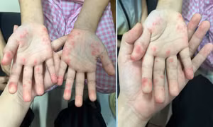 Bệnh nhi hai lần bị chẩn đoán nhầm vì căn bệnh tự miễn ‘giấu mặt’
