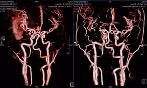 Cứu sống nam sinh hôn mê sâu do vỡ mạch máu não