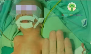 ‘Nhường’ máu nuôi người anh song thai, bé trai sinh non nguy kịch