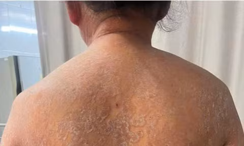 Lạm dụng thuốc bôi không rõ nguồn gốc, người phụ nữ mắc nấm da toàn thân