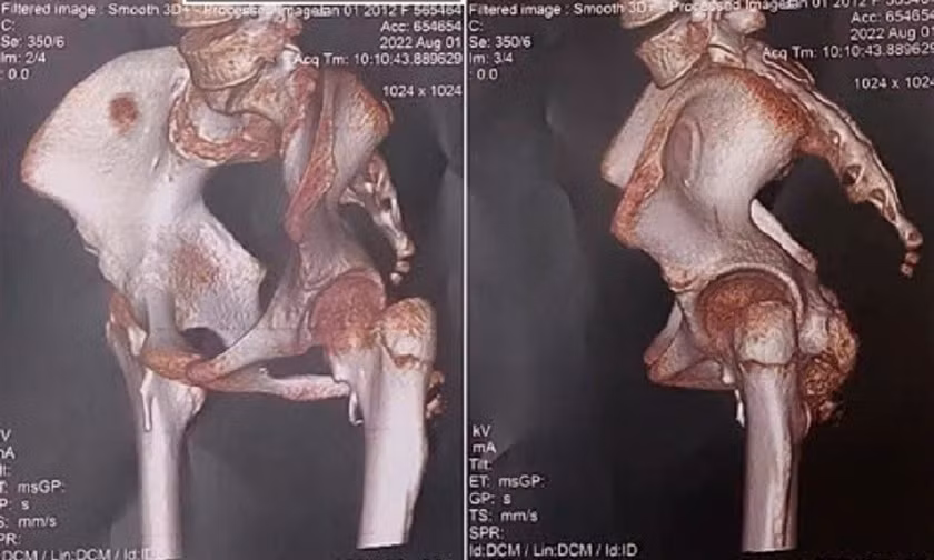Phát hiện bé gái mắc hội chứng 'người hóa đá' cực hiếm
