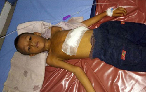 Ritesh đang phục hồi trong bệnh viện sau ca phẫu thuật cắt bỏ bào thai song sinh. Ảnh: Barcroft.