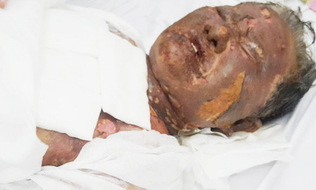 Bà Can đang nằm điều trị bỏng tại bệnh viện