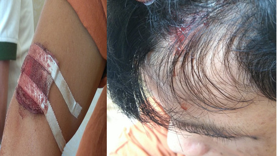 Những vết thương trên người anh L