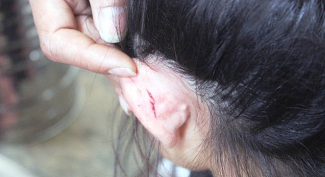 Vết thương ở phía sau vành tai trái của bé Tr.