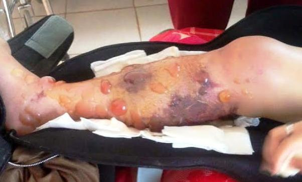 Chân Vi trước lúc bị cưa. Ảnh gia đình nạn nhân cung cấp